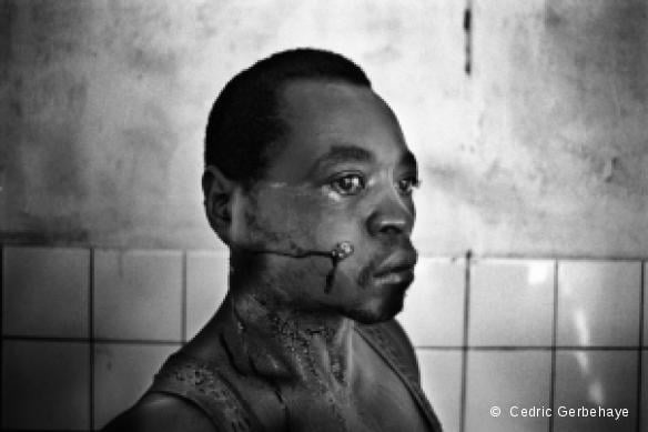 Un blessé dans l'hôpital de Masisi, Nord Kivu - République démocratique du Congo, décembre 2007