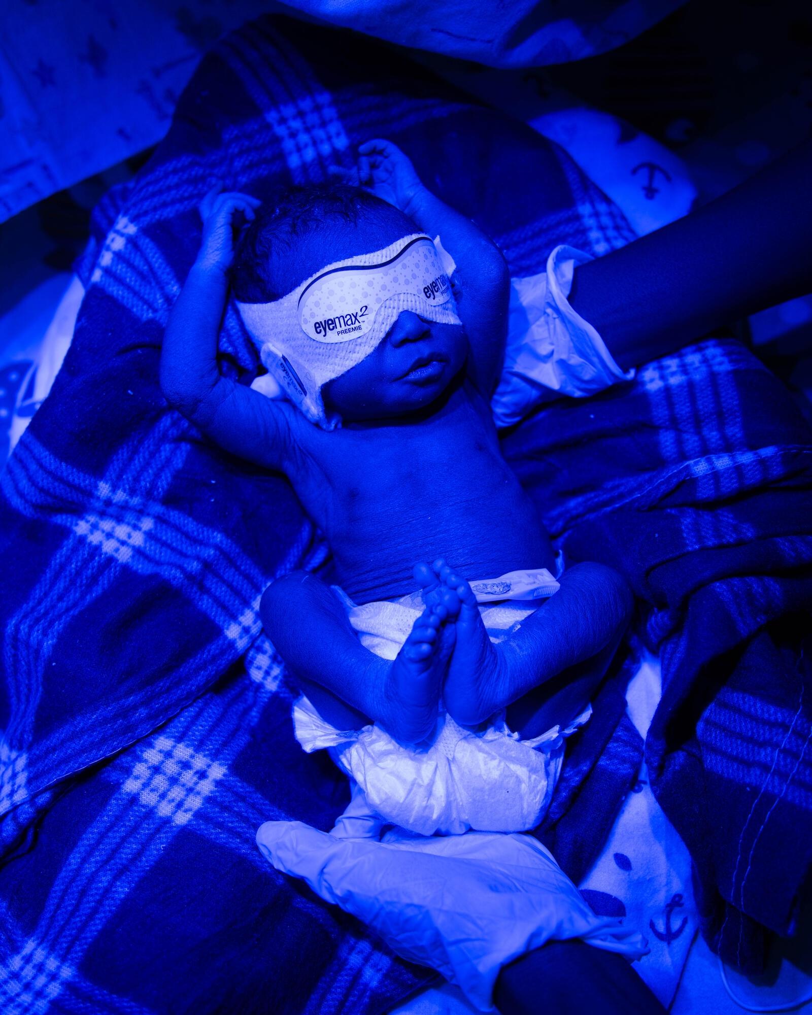 Vue d'un enfant prématuré souffrant de jaunisse et placé sous lampe UV.