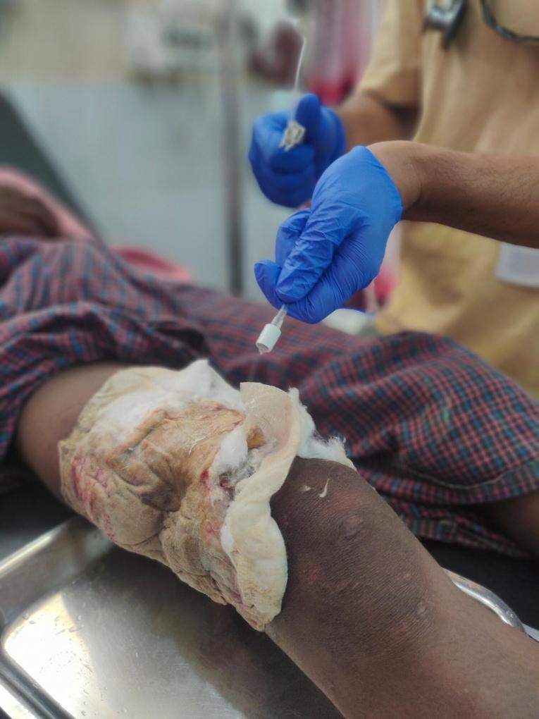 Un adolescent rohingya est arrivé à l'hôpital MSF avec une grave blessure à la jambe en provenance du Myanmar. Le personnel de MSF nettoie la zone de la blessure.
 © MSF